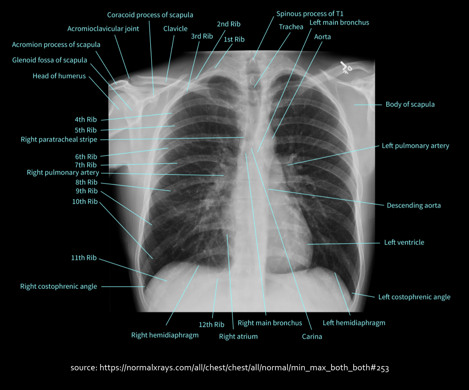 Labeled Normal Chest X Ray