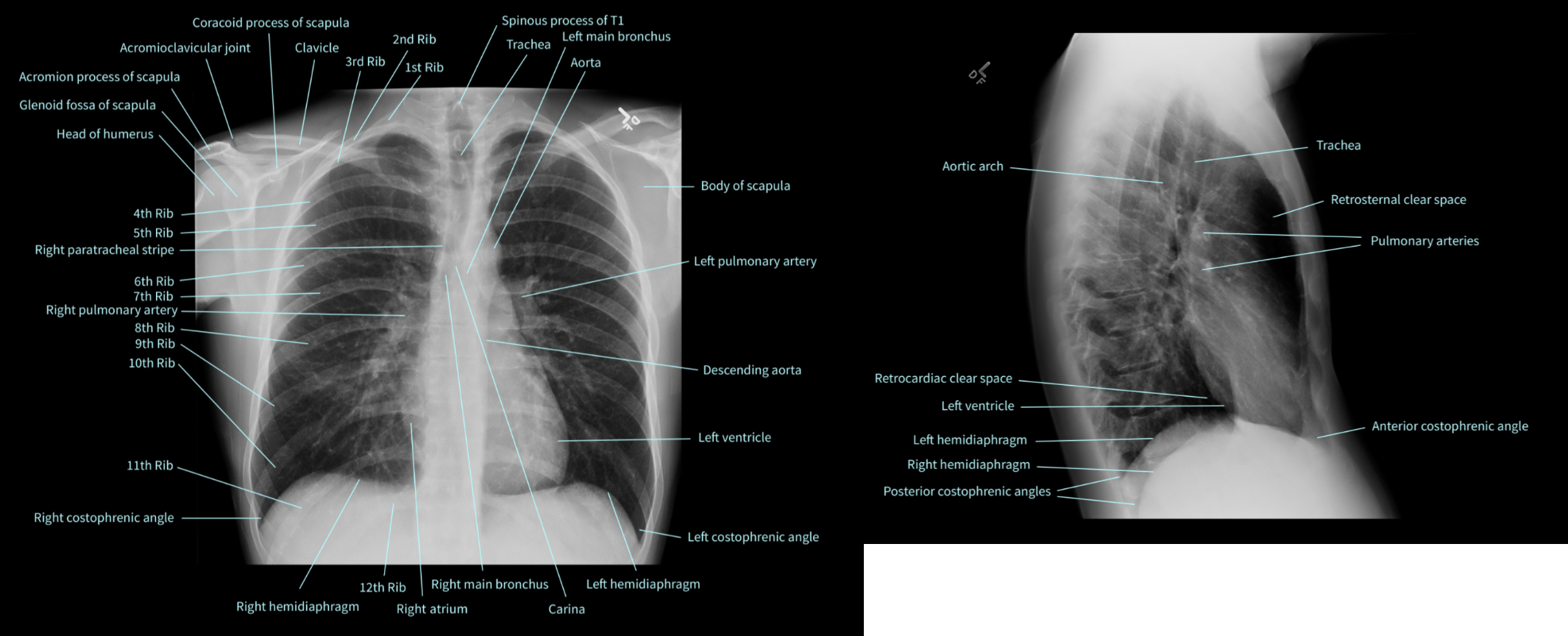 collection-of-labeled-normal-reference-x-rays-from-normalxrays